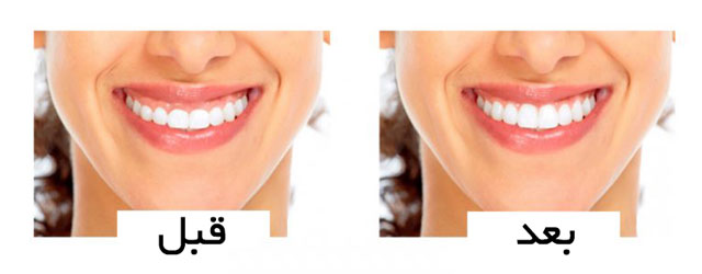 قبل و بعد از درمان لبخند لثه ای
