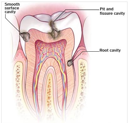 انواع حفره دندانی