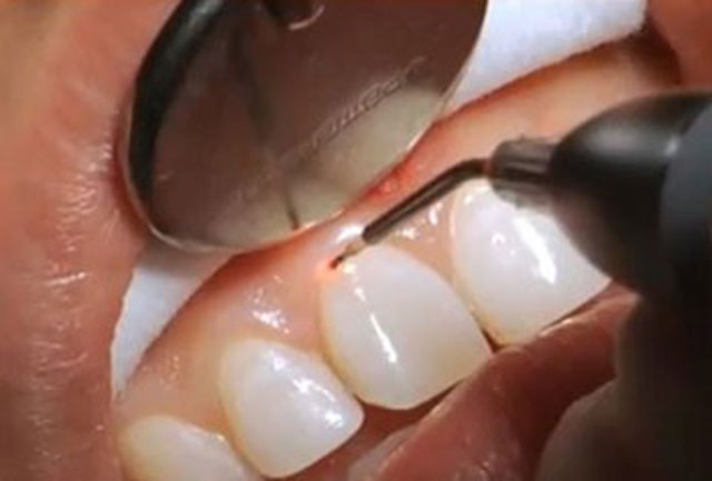 مزایای لیزر درمانی برای افزایش طول تاج دندان
