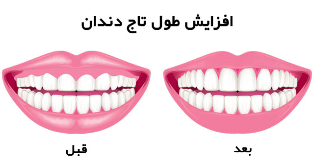 قبل و بعد از افزایش طول تاج دندان
