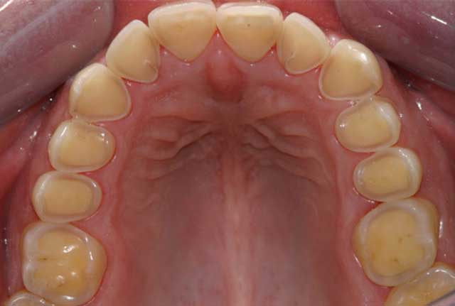 اثر رفلاکس معده بر دندان­ها