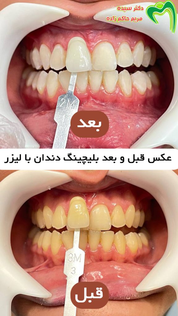 عکس قبل و بعد از سفید کردن دندان با لیزر