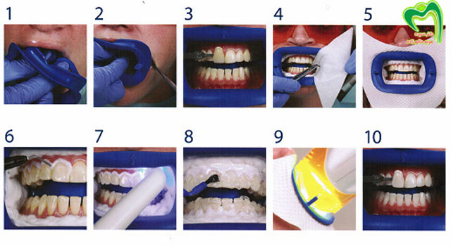 مراحل سفید کردن دندان با لیزر