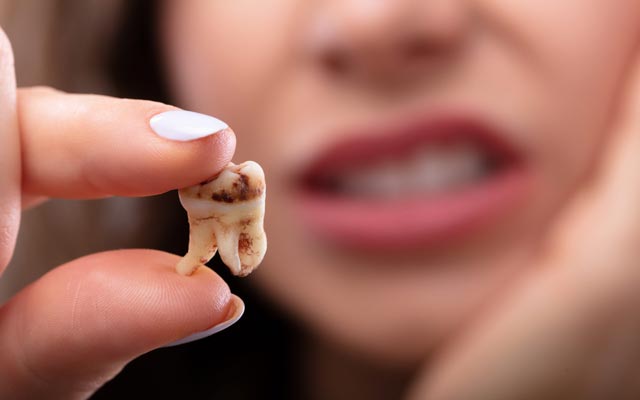 پوسیدگی دندان و حفره دندانی