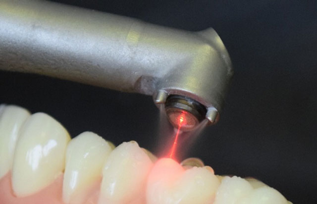 دندانپزشکی با لیزر چگونه انجام میگیرد؟