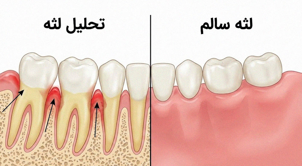 مقایسه لثه سالم و لثه دچار تحلیل با ریشه دندان نمایان در کنار هم