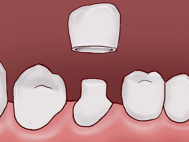 قرار دادن تاج برای درمان شکستگی دندان