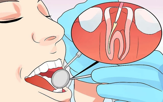 فرایند عصب کشی دندان