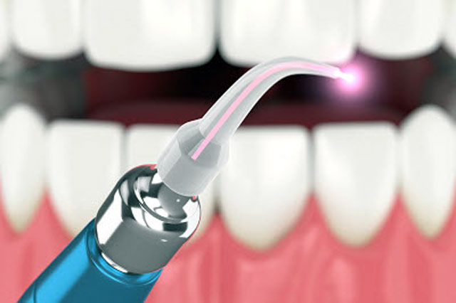 جلوگیری از تحلیل لثه بوسیله لیزر دندانپزشکی
