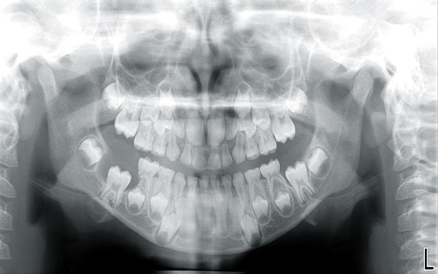 جراحی ضایعه و کیست لثه و دندان با لیزر