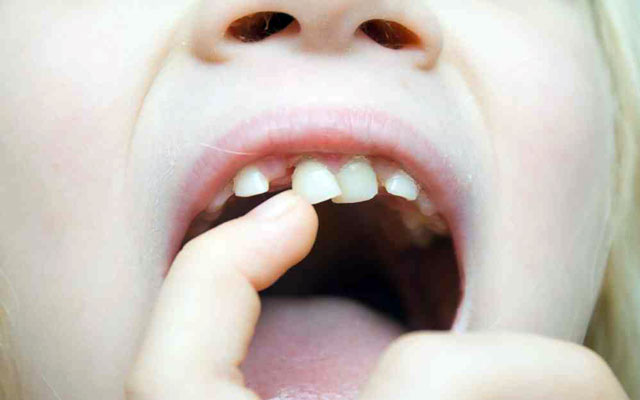 کشیدن دندان کودکان و دندان شیری