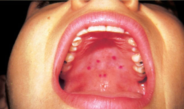 زخم در سقف دهان: نشانه ی ویروس کرونا