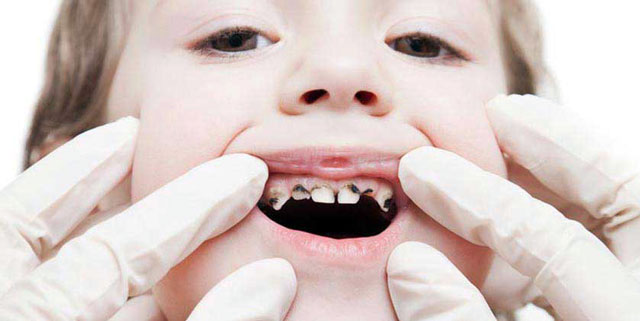 دلایل کشیدن دندان شیری