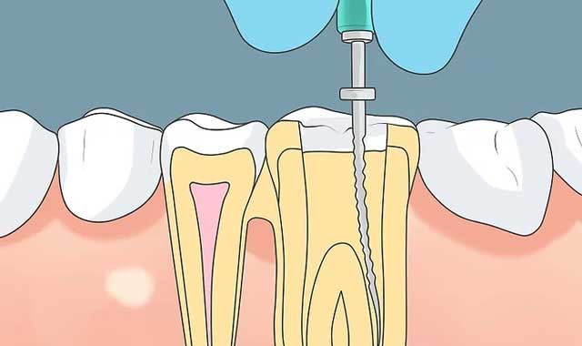 پرسش درباره نیاز به عصب کشی دندان عفونتی