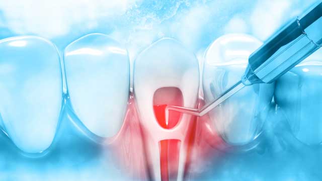 عصب کشی دندان با لیزر
