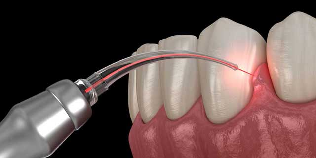 gum-disease-treatment-laser-graphic-opt