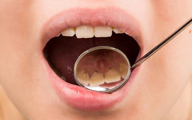 جرم و پلاک دندان چیست؟