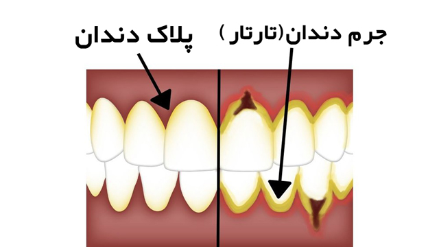 تفاوت جرم دندان و پلاک دندان