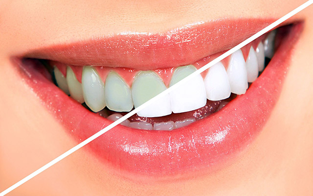 سفید کردن دندان (بلیچینگ)