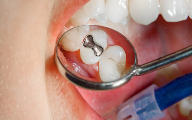 مراقبت های بعد از پر کردن دندان و ترمیم