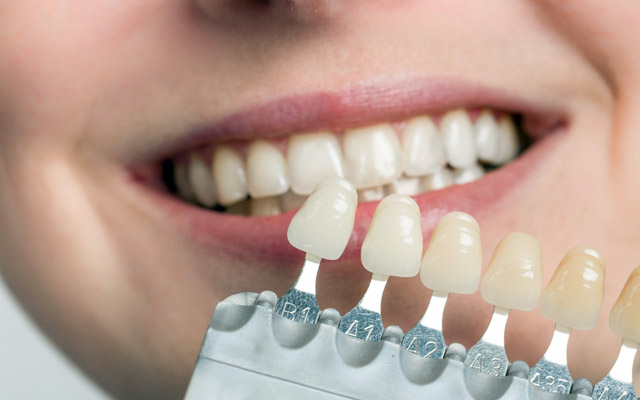 تفاوت باندینگ و کامپوزیت ونیر دندان