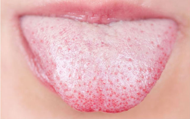 علت سفیدی زبان و بوی بد دهان