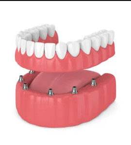 جایگزینی دندان کشیده شده با ایمپلنت