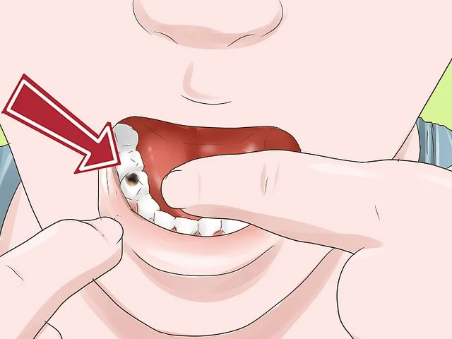 نشانه های تعویض پرکردگی دندان