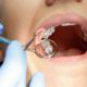تعویض پرکردگی دندان