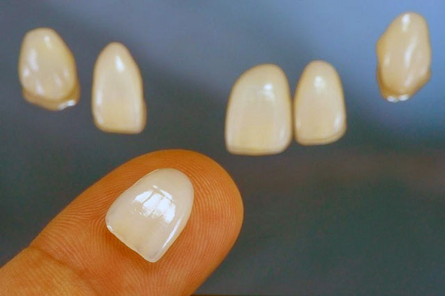  انواع لمینت های دندان