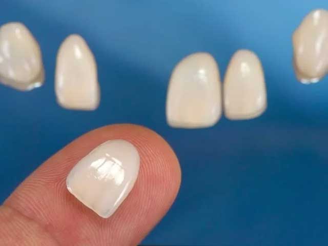 مشکلاتی که توسط لمینت دندان و ایمپلنت دندان حل می‌شوند