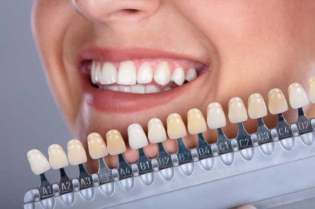 چطور رنگ مناسب لمینت‌های دندان خود را انتخاب کنید؟