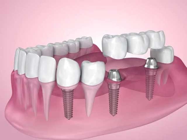 روند قرار دادن ایمپلنت دندان