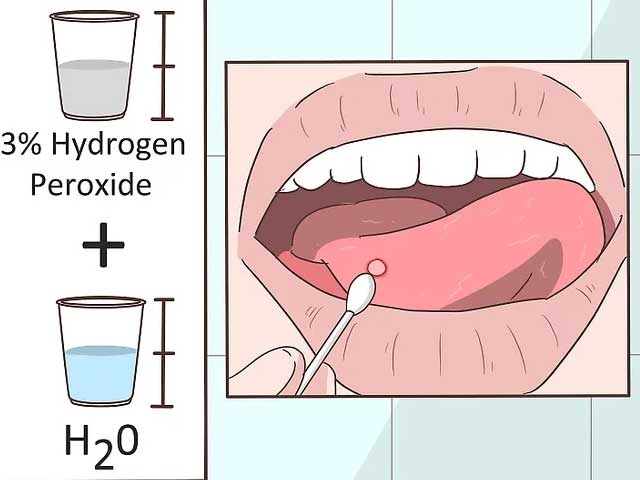 درمان زخم دهان با پراکسید هیدروژن