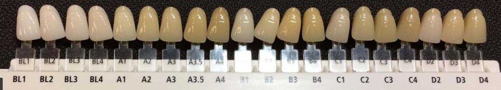 انواع رنگ لمینت دندان