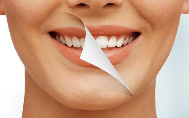 سفید کردن کامپوزیت دندان