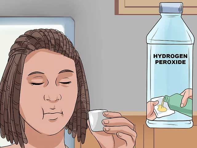 استفاده از محلول پراکسید هیدروژن برای درمان درد سوراخ شدن دندان