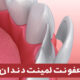 عفونت لمینت دندان