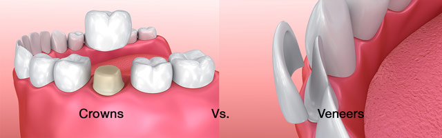 مقایسه عمر لمینت دندان در مقابل تاج دندان