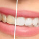 دلایل سفید نشدن دندان ها و راه حل