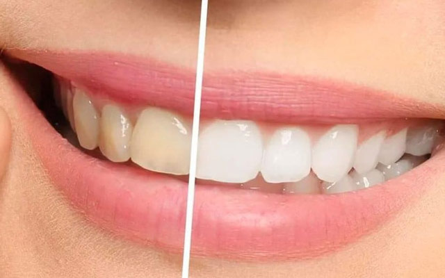 دلایل سفید نشدن دندان ها و راه حل