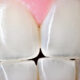 دلایل شفاف و شیشه ای بودن دندان و نحوه درمان