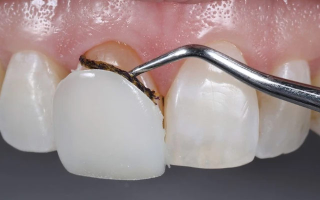آیا روکش دندان ها قابل برداشتن هستند؟