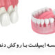 ایمپلنت دندان بهتر است یا روکش دندان