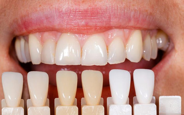 تفاوت لومینیرز دندان با روکش های لمینت و کامپوزیت