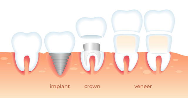 مقایسه روکش دندان با ایمپلنت
