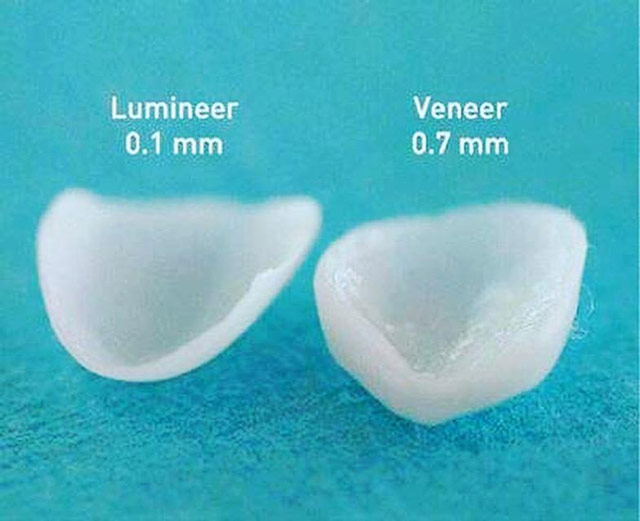 تفاوت لمینت دندان و لومینیرز