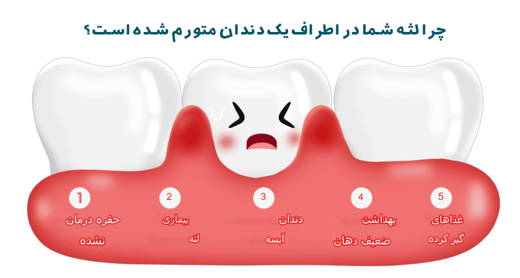 7 دلیل ایجاد تورم لثه در اطراف یک دندان
