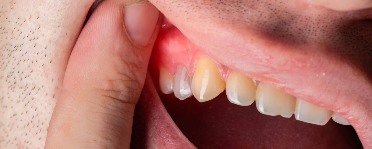 چرا لثه من در اطراف یک دندان متورم شده است؟