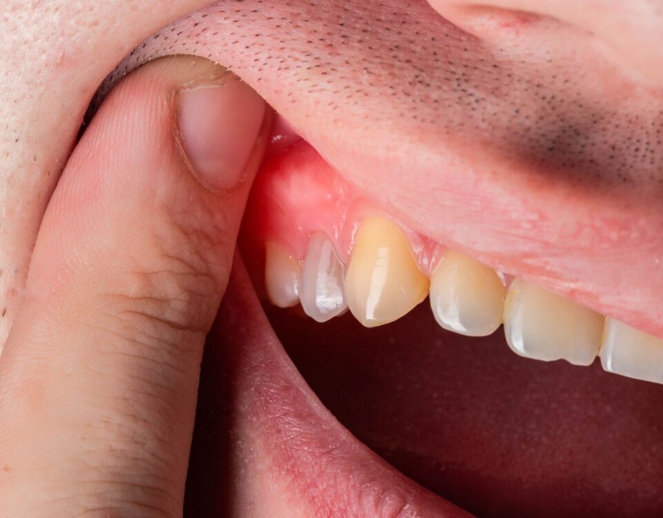 چرا لثه من در اطراف یک دندان متورم شده است؟